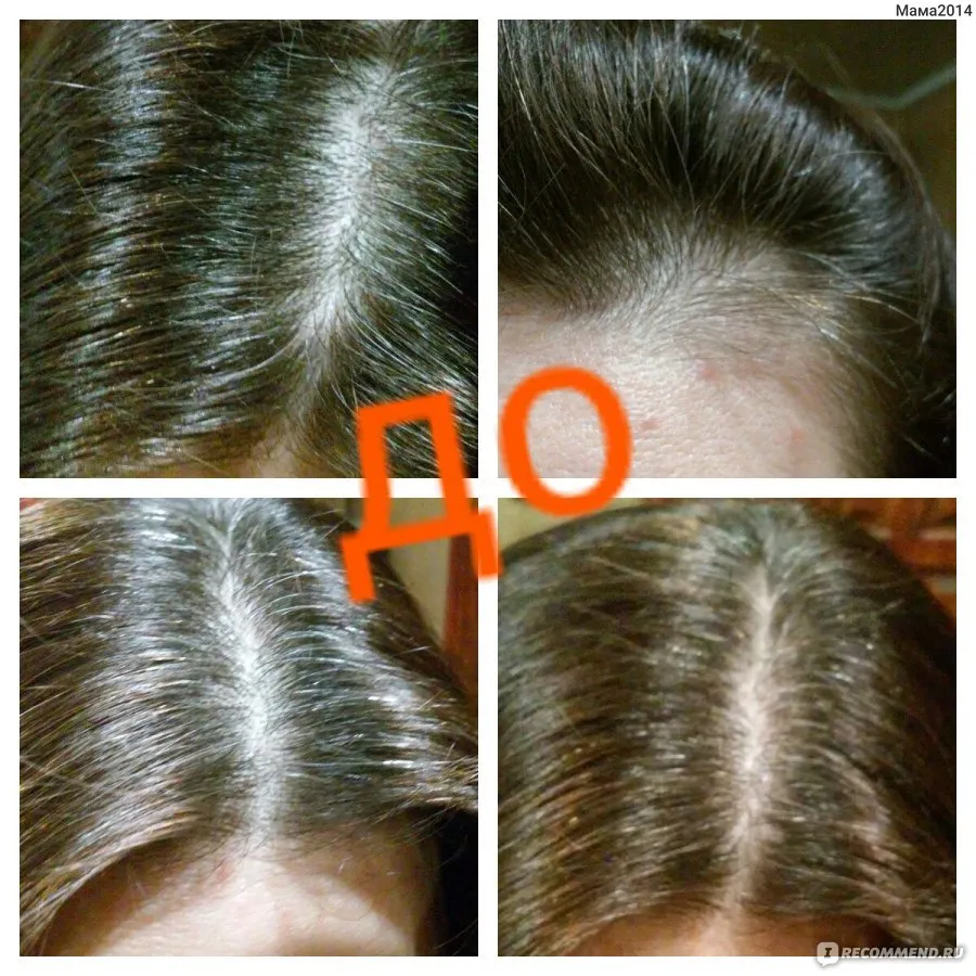 Фото до и после мезотерапии волос