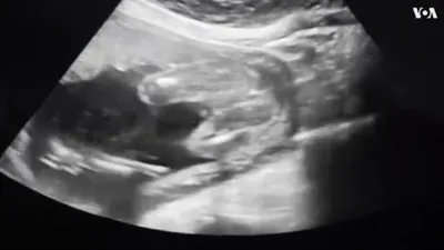 Американские врачи и правозащитники – о возможных последствиях запрета на  аборт в США