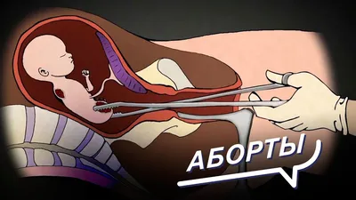 Имеет ли женщина право убить не рожденного ребенка? За и Против абортов.  Шоу: Все говорят об этом - YouTube