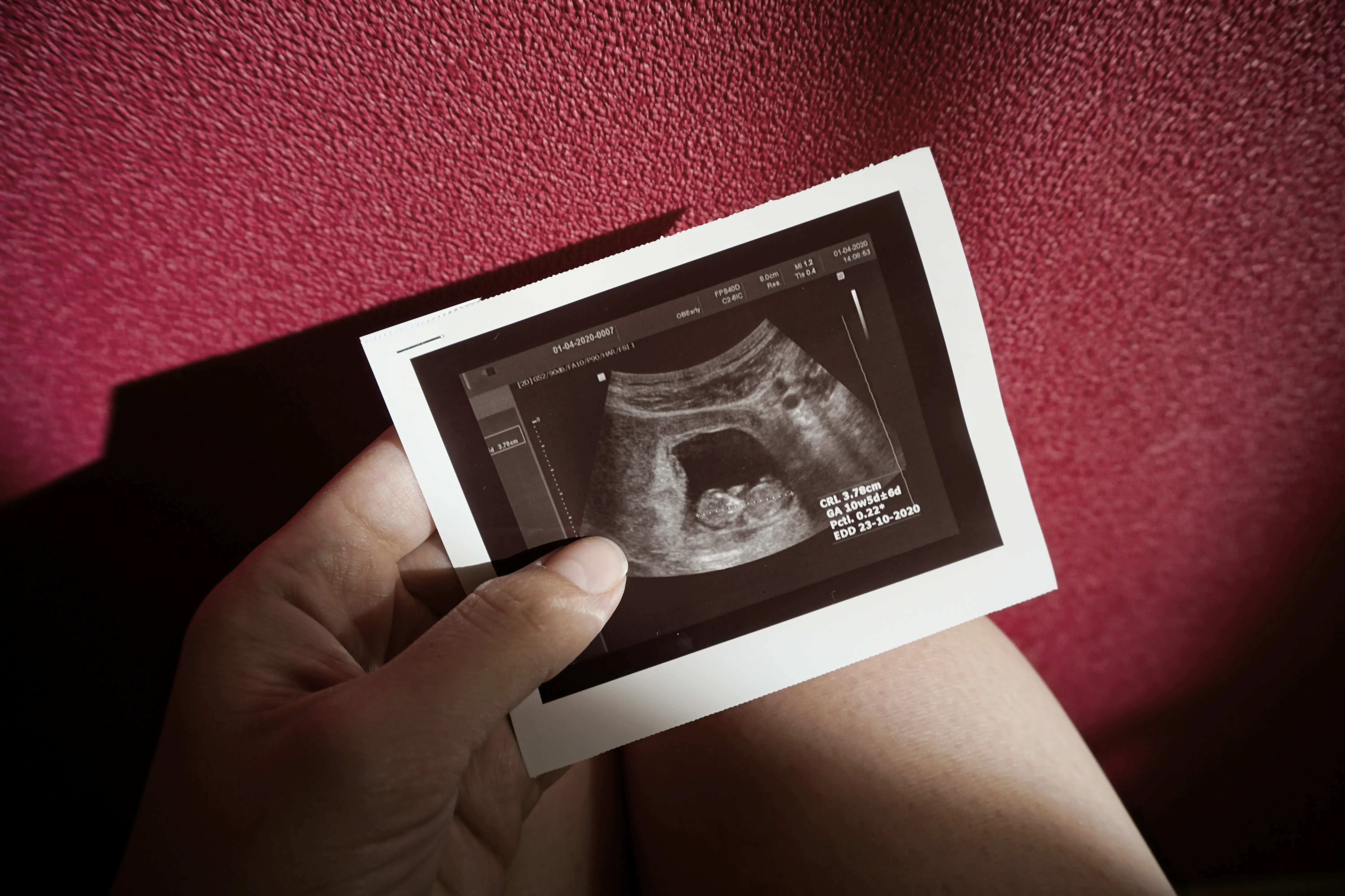 11 неделя признаки. 13 Акушерских недель беременности фото плода на УЗИ. Снимок УЗИ 11 недель. УЗИ 13 недель беременности. Снимок УЗИ на 12 неделе беременности.