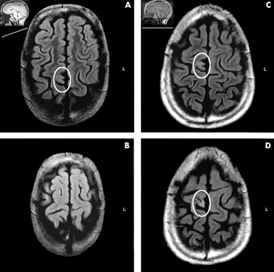Все о диагностике эпилепсии на МРТ - симптомы, протокол, признаки на МРТ  снимке