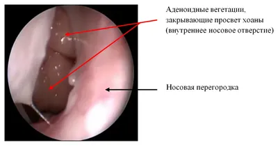 Аденотомия. Пора или не пора удалять аденоиды? - НЦЗД