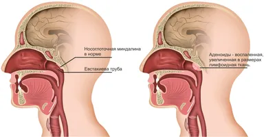 Аденотомия для детей