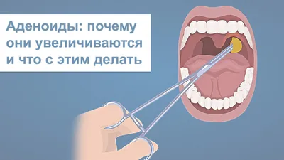 Аденоиды: почему они увеличиваются и что с этим делать | Журнал Доктора  Комаровського