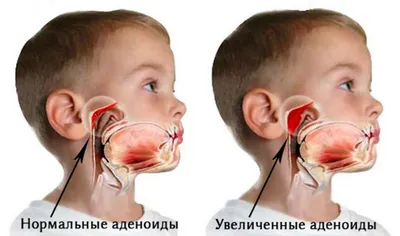 Лазерное удаление аденоидов