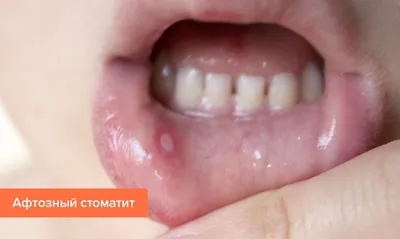 ᐈ Стоматит на языке у детей: фото ᐈ Как и чем лечить стоматит на языке  ребенка