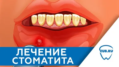 Стоматит – причины, симптомы, признаки, диагностика, лечение у взрослых и  детей в Москве - цены, отзывы в стоматологических клиниках Зуб.ру