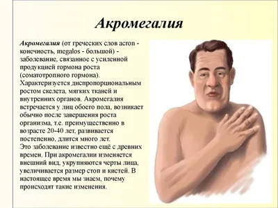 Акромегалия. Клиническая картина заболевания - online presentation