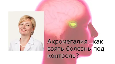 Астафьева Л.И.: Акромегалия. Как взять болезнь под контроль? | «ВЕЛИКАН» -  Благотворительная Общественная Организация пациентов с акромегалией и  аденомами гипофиза