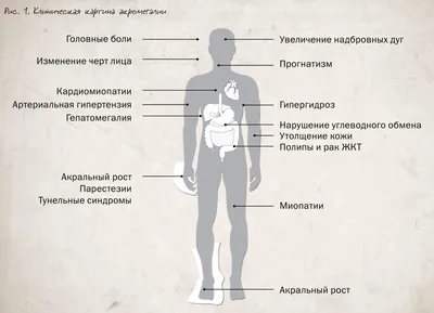 Акромегалия. Определение, эпидемиология, клиника, диагностика и лечение  акромегалии.