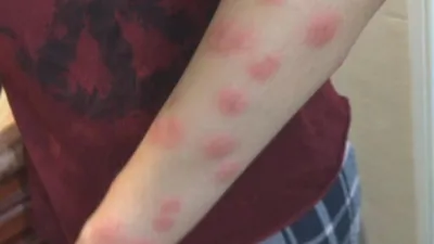 Аллергия на укусы клопов у детей и взрослых: как выглядит и чем лечить
