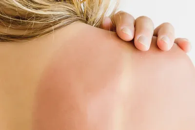 Аллергия на солнце: симптомы, причины, лечение | РБК Стиль