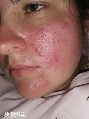 Сыпь на лице, аллергическая реакция - Вопрос дерматологу - 03 Онлайн