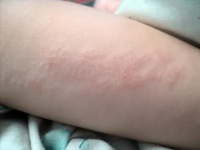 Аллергическая сыпь у детей на коже: фото высыпаний и методы лечения