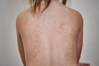Аллергическая сыпь на теле больного. 5-летняя девочка. вызвано реакцией на  антибиотики. | Премиум Фото