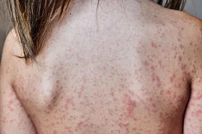 Аллергическая сыпь на теле больного. 5-летняя девочка. вызвано реакцией на  антибиотики. | Премиум Фото