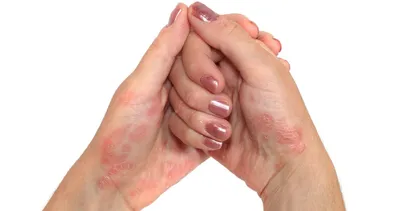 Уход за кожей при псориазе: гигиенические процедуры, косметические  средства, образ жизни