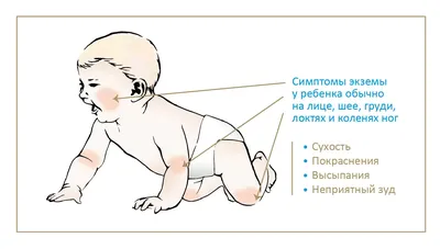 Аллергия на коровье молоко у ребенка - формы аллергии, симптомы, диета