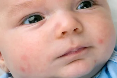 У ребенка резко появилась аллергия на молоко. Почему такое может быть? | О  детском здоровье: с врачебного на родительский | Дзен