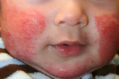 Самые частые аллергены у малыша до года — Алёна Парецкая на TenChat.ru