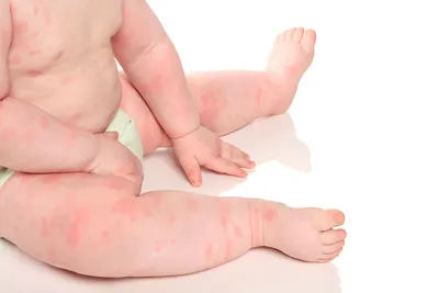Как справиться с атопическим дерматитом у малышей - KP.RU