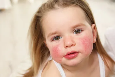 Как уберечь малыша от аллергии? Девять фактов о профилактике заболевания |  The-steppe.com