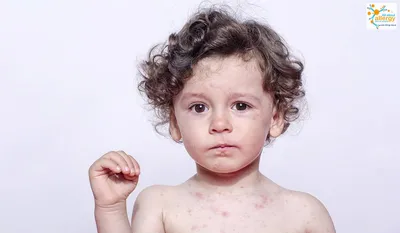 Аллергия на коже: проявления, симптомы, лечение - Все про аллергию
