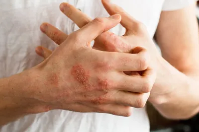 Аллергические заболевания кожи, связанные с окружающей средой и питанием. |  Газета \