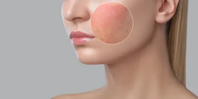 Аллергия на крем для лица: подбираем безопасную альтернативу | WOMAN
