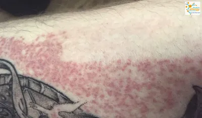 Аллергия на татуировку может привести к сепсису и раку кожи - Все про  аллергию