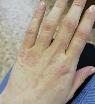 Аллергия на латексные перчатки фотографии