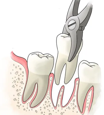Удаление зуба. Осложнение - Центр ортодонтии №1
