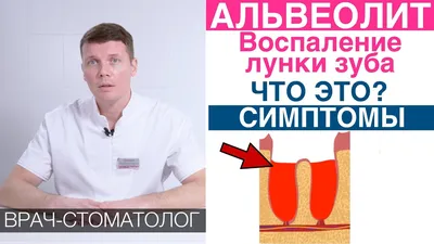 Альвеолит - воспаление лунки зуба после удаления зуба, как часто  встречается, симптомы - YouTube