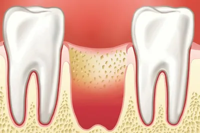 Альвеолит ▶️ Лечение альвеолита после удаления зуба в Ирпене | MySmile®