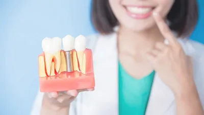 Имплантация зубов в Екатеринбурге | Цены на зубные импланты в стоматологии  АльфаБета