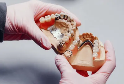 Имплантация жевательных зубов по низкой цене под ключ в Екатеринбурге.  Особенности имплантации жевательных имплантов в стоматологии АльфаБета