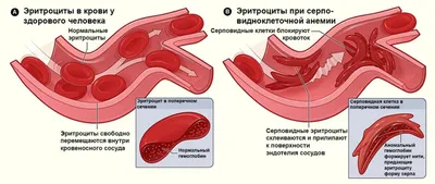 Анемия (малокровие): симптомы, лечение, степени, виды