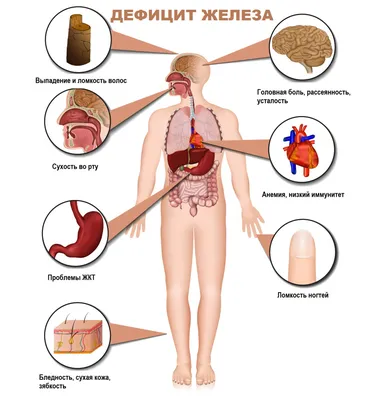 Железодефицитная анемия: как лечить, симптомы анемии