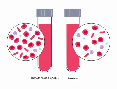 21 643 рез. по запросу «Анемия» — изображения, стоковые фотографии и  векторная графика | Shutterstock
