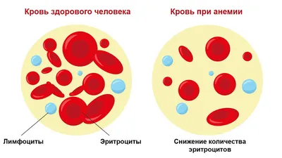 Анемия (малокровие): симптомы, лечение, степени, виды