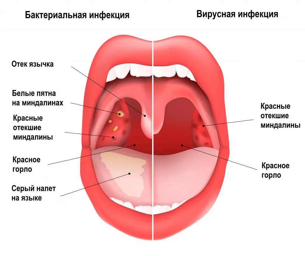 Ангина симптомы отличие от орви у взрослого без температуры фото