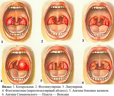 Компресс при ангине: будет ли полезным прогревание горла?