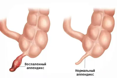 Острый аппендицит