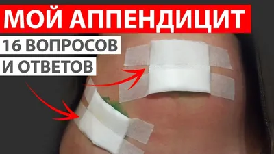 МОЙ АППЕНДИЦИТ. КАК ВСЁ БЫЛО. 16 ВОПРОСОВ И ОТВЕТОВ. СИМПТОМЫ АППЕНДИЦИТА  #healthy_help - YouTube