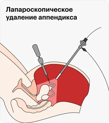 Что такое аппендицит и как его определить