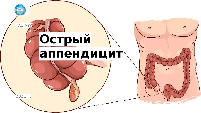 Острый аппендицит, диагностика, клиника, первая помощь, лечение |  Презентации Хирургия | Docsity