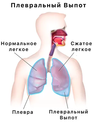 Плевральный выпот — Википедия