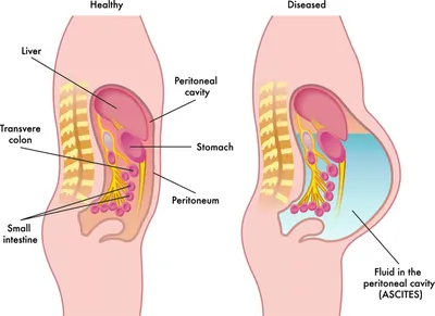 Лапароцентез брюшной полости при асците | Клиника НАКФФ