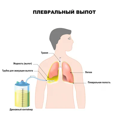 Гидроторакс - причины появления, при каких заболеваниях возникает,  диагностика и способы лечения