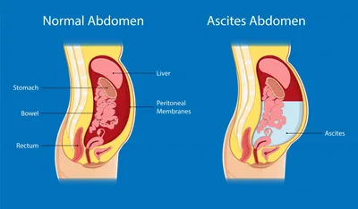 Асцит - причины, симптомы, диагностика и лечение, прогноз